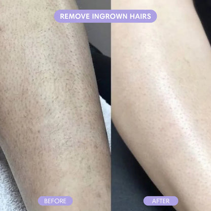 Magic Hair Eraser - Laser Removal At Home