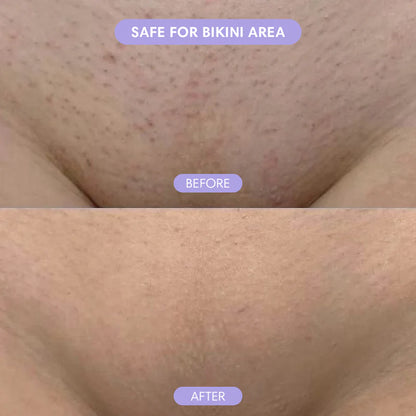 Magic Hair Eraser - Laser Removal At Home